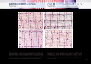 E L E K T R O K A R D I O G R A F I A K O AT L A S A 			 AT L A S D E E L E C T R O C A R D I O G R A F í A / 7 /
TAKIARRITMIAK TAQUIARRITMIAS
/ 198 /
Flutter aurikular alderantzikatua. Eskuin-aurikularen inguruan erloju-
orratzen norabideko biraketa duen flutter aurikularraren EKG tipikoa (“erloju-
orratzen norabideko” flutterra). Aurrekoa baino askoz gutxiagotan agertzen da.
Bentrikulura eroateko mailak (3/1 edo 4/1 modukoa izan daiteke) aukera ematen
du F uhinak ondo ikusteko (tipikoki positiboak beheko aurpegian, negatiboak V1
-
ean eta positiboak V6
-an, erloju-orratzen kontrako flutterraren alderantziz).
Flutter auricular inverso. ECG típico de un flutter auricular con giro horario
alrededor de la aurícula derecha (flutter “horario”). Es mucho menos
frecuente que el anterior. El grado de conducción al ventrículo (variable
entre 3/1 y 4/1) permite ver bien las ondas F (típicamente positivas en
cara inferior, negativas en V1
y positivas en V6
, justo al contrario que el
flutter antihorario).
I
II
III
aVR
aVL
aVF
V1
V2
V3
V4
V5
V6
 