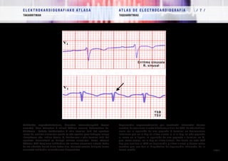 E L E K T R O K A R D I O G R A F I A K O AT L A S A 			 AT L A S D E E L E C T R O C A R D I O G R A F í A / 7 /
TAKIARRITMIAK TAQUIARRITMIAS
/ 209 /
Takikardia suprabentrikularra, birsartze intranodalagatik (forma
arrunta). Kasu batzuetan P uhinak QRSren amaiera deformatzen du.
Ohizkoena beheko deribazioetan S uhin terminal txiki bat agertzea
izaten da, erritmo sinusalean agertu ez edo agertuz gero txikiagoa izango
litzatekeena edo, irudian bezala, V1
deribazioan r uhin terminal txiki bat
agertzea, horrelakorik ez baitago erritmo sinusalean. Beraz, edozein
TSBetan QRS konplexua takikardian eta erritmo sinusalean aztertu behar
da eta aldaketa horiek bilatu behar dira, horiexek ematen baitigute forma
arrunteko takikardia intranodalaren diagnostikoa.
Taquicardia supraventricular por reentrada intranodal (forma
común). En ocasiones la onda P deforma el final del QRS. Lo más habitual
suele ser la aparición de una pequeña S terminal en derivaciones
inferiores que no la hay en ritmo sinusal o, si la hay, es más pequeña
o, como en la figura, la aparición de una pequeña r terminal en V1
que, como vemos, no la hay en ritmo sinusal. Por tanto, en toda TSV
hay que analizar el QRS en taquicardia y ritmo sinusal y buscar estos
cambios que nos dan el diagnóstico de taquicardia intranodal de la
forma común.
Erritmo sinusala
R. sinusal
TSB
TSV
 