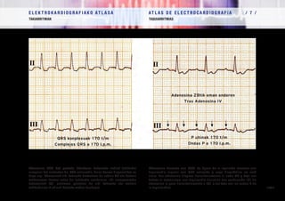 E L E K T R O K A R D I O G R A F I A K O AT L A S A 			 AT L A S D E E L E C T R O C A R D I O G R A F í A / 7 /
TAKIARRITMIAK TAQUIARRITMIAS
/ 214 /
Adenosina TSB bat gertatu bitartean: Ezkerreko irudiak takikardia
erregular bat erakusten du, QRS estuarekin, baina horren diagnostikoa ez
dago argi. Adenosinak aldi baterako blokeatzen du nodulu AB eta behean
mekanismoa ikusten uzten du: takikardia aurikularra, 1/1 eroapenarekin
(adenosinak 2/1 erritmora pasatzen du aldi baterako eta horrela
takikardiaren P uhinak ikusteko modua daukagu).
Adenosina durante una TSV: La figura de la izquierda muestra una
taquicardia regular con QRS estrecho y cuyo diagnóstico no está
claro. Las adenosina bloquea transitoriamente el nodo AV y deja ver
debajo el mecanismo: una taquicardia auricular con conducción 1/1 (la
adenosina la pasa transitoriamente a 2/1 y así deja ver las ondas P de
la taquicardia).
Adenosina ZBtik eman ondoren
Tras Adenosina IV
P uhinak 170 t/m
Ondas P a 170 l.p.m.
QRS konplexuak 170 t/m
Complejos QRS a 170 l.p.m.
 