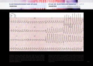 E L E K T R O K A R D I O G R A F I A K O AT L A S A 			 AT L A S D E E L E C T R O C A R D I O G R A F í A / 7 /
TAKIARRITMIAK TAQUIARRITMIAS
/ 219 /
Takikardia erregular baten EKG: QRS zabala 220 t/m-ra eta EsABren
morfologia eta beheko ardatza. Brugadaren lehen irizpidea aplikatzen
badugu, ez dagoela bat ere RSrik bihotz aurrekoetan ikusiko dugu (QRS
guztiak R hutsak dira, konkordantzia positiboa bezala ezagutzen dena).
Hori TBren aldekoa da. Paziente honek beheko infartu zaharra zuen eta
takikardia bentrikularra.
ECG de una taquicardia regular con QRS ancho a 220 lpm y morfología
de BRD y eje inferior. Si aplicamos el primer criterio de Brugada
vemos que no hay ningún RS en precordiales (todos los QRS son R
pura, lo que se conoce como concordancia positiva). Ello va a favor
de TV. Era un paciente con infarto inferior antiguo y taquicardia
ventricular.
 