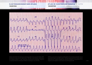 E L E K T R O K A R D I O G R A F I A K O AT L A S A 			 AT L A S D E E L E C T R O C A R D I O G R A F í A / 7 /
TAKIARRITMIAK TAQUIARRITMIAS
/ 227 /
Eskuin-bentrikuluko displasia arritmogenikoa duen paziente baten EKG.
Takikardia erregularra da, QRS zabala 140 t/m-ra eta EzABren morfologia
eta beheko ardatza. Ia beti eskuineko bentrikulutik datozenez, displasia
arritmogenikoaren takikardiek EzABren morfologia izan ohi dute.
ECGdeunpacientecondisplasia arritmogénica de ventrículo derecho. Esuna
taquicardia regular con QRS ancho a 140 lpm y morfología de BRI y eje inferior.
Dado que casi siempre proceden del ventrículo derecho, las taquicardias de la
displasia arritmogénica suelen tener una morfología de BRI.
 