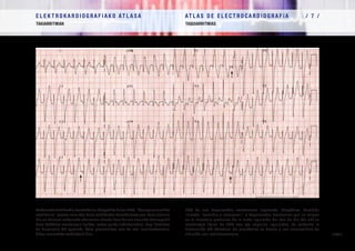 E L E K T R O K A R D I O G R A F I A K O AT L A S A 			 AT L A S D E E L E C T R O C A R D I O G R A F í A / 7 /
TAKIARRITMIAK TAQUIARRITMIAS
/ 229 /
Ezkerreko takikardia bentrikular idiopatikobatenEKG.“Verapamilarekiko
sentikorra” esaten zaio edo baita takikardia faszikularra ere, bere jatorria
His-en balaren ezkerreko adarraren atzeko faszikuluan duelako (horregatik
bere EsABren morfologia tipikoa, ezker-goiko ardatzarekin). Begi-bistakoa
da disoziazio AB (geziak). Bere pronostikoa ona da eta irratifrekuentzia
bidez erauzteko modukoak dira.
ECG de una taquicardia ventricular izquierda idiopática. También
llamada “sensible a verapamil” o taquicardia fascicular por su origen
en el fascículo posterior de la rama izquierda del haz de His (de ahí su
morfología típica de BRD con eje superior izquierdo). Es evidente la
disociación AV (flechas). Su pronóstico es bueno y son susceptibles de
ablación con radiofrecuencia.
 