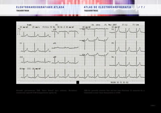 E L E K T R O K A R D I O G R A F I A K O AT L A S A 			 AT L A S D E E L E C T R O C A R D I O G R A F í A / 7 /
TAKIARRITMIAK TAQUIARRITMIAS
/ 235 /
Aurreko pazientearen EKG, flexio batzuk egin ondoren. Maiztasun
sinusalaren igoerak EIBA desagerrarazi egiten du.
ECG del paciente anterior tras realizar unas flexiones. El aumento de la
frecuencia sinusal hace desaparecer el RIVA.
 