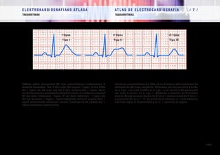E L E K T R O K A R D I O G R A F I A K O AT L A S A 			 AT L A S D E E L E C T R O C A R D I O G R A F í A / 7 /
TAKIARRITMIAK TAQUIARRITMIAS
/ 254 /
EKGren patroi ezaugarriak QT luze sortzetikoaren sindromearen 3
formarik usuenetan. Ikusi T uhin zabal bat dagoela I tipoan, T uhin bifido
bat II tipoan eta QT tarte luze bat T uhin normalarekin III tipoan. Kanal
ioniko diferenteetan gertatutako akatsak dira forma kliniko horien arrazoiak
(K+
-ren kanal bizkorretan I tipoan, K+
-ren kanal moteletan II tipoan eta
Na+
-ren kanaletan III tipoan. I tipoak esfortzuko arritmiak eragiten ditu, II
tipoak entzumeneko estimuluen aurrean (iratzargailua da tipikoa) eta III
tipoan atsedenean agertzen dira.
Patrones característicos del ECG en las 3 formas más frecuentes de
síndrome de QT largo congénito. Obsérvese que hay una onda T ancha
en el tipo I, una onda T bífida en el tipo II y un intervalo QT prolongado
con onda T normal en el tipo III. Obedecen a defectos en diferentes
canales iónicos (canales rápidos de K+
en el I, canales lentos de K+
en el II
y canales de Na+
en el III. El I da arritmias de esfuerzo, el II ante estímulos
auditivos (típico el despertador) y en el III aparecen en reposo.
I tipoa
Tipo I
II tipoa
Tipo II
III tipoa
Tipo III
 