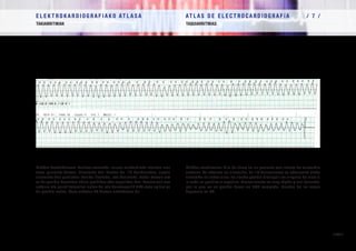 E L E K T R O K A R D I O G R A F I A K O AT L A S A 			 AT L A S D E E L E C T R O C A R D I O G R A F í A / 7 /
TAKIARRITMIAK TAQUIARRITMIAS
/ 259 /
Flutter bentrikularra. Erritmo-zerrenda, aurrez miokardioko infartua izan
duen paziente batean. Sinusoide bat ikusten da. 12 deribaziotan, aipatu
sinusoide hori guztietan ikusiko litzateke, eta horietako bakar batean ere
ez da posible bereiztea uhina positiboa edo negatiboa den. Normalean oso
azkarra eta gaizki toleratua izaten da, eta horrexegatik EKG osoa egitea ez
da posible izaten. Kasu askotan FB batean endekatzen da.
Flutter ventricular. Tira de ritmo en un paciente con infarto de miocardio
anterior. Se observa un sinusoide. En 12 derivaciones se observaría dicho
sinusoide en todas ellas, no siendo posible distinguir en ninguna de ellas si
la onda es positiva o negativa. Normalmente es muy rápido y mal tolerado,
por lo que no es posible hacer un ECG completo. Muchas de las veces
degenera en FV.
 