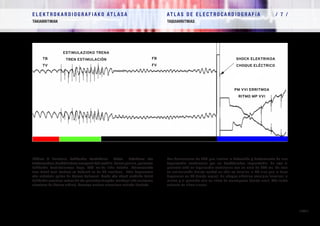 E L E K T R O K A R D I O G R A F I A K O AT L A S A 			 AT L A S D E E L E C T R O C A R D I O G R A F í A / 7 /
TAKIARRITMIAK TAQUIARRITMIAS
/ 268 /
EKGren bi deribazio, takikardia bentrikular baten detekzioa eta
tratamendua, desfibriladore ezargarri bat erabiliz.Koloregorrian,pazientea
takikardia bentrikularrean dago, 280 ms-ko ziklo batekin. Estimulazioko
tren batek (zati berdea) ez bakarrik ez du TB amaitzen, FBra degeneratu
edo endekatu egiten du (kolore beltzean). Txoke edo shock elektriko batek
takikardia amaitzea lortzen du eta pazientea taupada-markagailuko erritmoan
ateratzen da (kolore urdina). Geroago erritmo sinusalean sartuko litzateke.
Dos derivaciones de ECG que ilustran la detección y tratamiento de una
taquicardia ventricular por un desfibrilador implantable. En rojo el
paciente está en taquicardia ventricular con un ciclo de 280 ms. Un tren
de estimulación (franja verde) no sólo no termina la TV sino que la hace
degenerar en FV (franja negra). Un choque eléctrico consigue terminar la
misma y el paciente sale en ritmo de marcapasos (franja azul). Más tarde
entraría en ritmo sinusal.
ESTIMULAZIOKO TRENA
TREN ESTIMULACIÓNTB
TV
FB
FV
SHOCK ELEKTRIKOA
CHOQUE ELÉCTRICO
PM VVI ERRITMOA
RITMO MP VVI
 