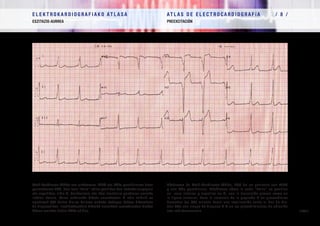 E L E K T R O K A R D I O G R A F I A K O AT L A S A 			 AT L A S D E E L E C T R O C A R D I O G R A F í A / 8 /
ESZITAZIO-AURREA PREEXCITACIÓN
/ 283 /
Wolf-Parkinson-White-ren sindromea. WPW eta BAkz parahisianoa duen
pazientearen EKG. Ikusi nola “delta” uhina positiboa den beheko aurpegian
eta negatiboa, aldiz V1
deribazioan, eta ikusi trantsizio goiztiarra aurreko
irudian bezala. Baina eskuineko bihotz aurrekoetan R uhin txikirik ez
agertzeak (QS baita) His-en balaren ondoko kokapen batera bideratzen
du diagnostikoa. Irratifrekuentzia bidezko erauzketa-prozeduretan blokeo
ABren arriskua duten BAkz-ak dira.
Síndrome de Wolf-Parkinson-White. ECG de un paciente con WPW
y una VAc parahisiana. Obsérvese cómo la onda “delta” es positiva
en cara inferior y negativa en V1
con la transición precoz como en
la figura anterior. Pero la ausencia de la pequeña R en precordiales
derechas (es QS) orienta hacia una localización junto al haz de His.
Son VAc con riesgo de bloqueo A-V en los procedimientos de ablación
con radiofrecuencia.
 