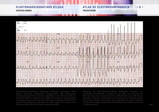 E L E K T R O K A R D I O G R A F I A K O AT L A S A 			 AT L A S D E E L E C T R O C A R D I O G R A F í A / 8 /
ESZITAZIO-AURREA PREEXCITACIÓN
/ 290 /
Wolf-Parkinson-White-ren sindromea. Fibrilazio aurikularra, BAkz
batean zeharreko aurreranzko eroapenarekin. QRS konplexuaren
morfologiak (positiboa V1
-ean eta negatiboa DI eta aVL-an) alboko eta
ezkerreko BAkz bat iradokitzen du. Tipikoa da arritmiaren irregulartasuna
eta konplexu zabalak zabalera-maila aldakorrekin, eroapena bi sistemetatik
egiten baita (zenbat eta zabalagoa izan QRS, orduan eta eroapen-maila
handiagoa BAkz-tik eta txikiagoa sistema normaletik).
Síndrome de Wolf-Parkinson-White. Fibrilación auricular con
conducción anterógrada a través de una VAc. La morfología del
QRS (positivo en V1
y negativo en DI y aVL) orienta a una VAc lateral
izquierda. Es típica la irregularidad de la arritmia y los complejos anchos
con grados variables de anchura por conducción por ambos sistemas
(a más ancho el QRS, mayor grado de conducción por la VAc y menor por
el sistema normal).
 