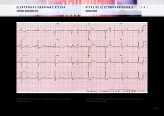 E L E K T R O K A R D I O G R A F I A K O AT L A S A 			 AT L A S D E E L E C T R O C A R D I O G R A F í A / 9 /
TAUPADA-MARKAGAILUAK MARCAPASOS
/ 329 /
Blokeo AB osoa. Blokeo AB osoa QRS estuarekin, nodulu ABaren
gaixotasunagatik.
Bloqueo A-V completo. Bloqueo AV completo con QRS estrecho por
enfermedad del nodo AV.
 