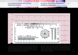 E L E K T R O K A R D I O G R A F I A K O AT L A S A 			 AT L A S D E E L E C T R O C A R D I O G R A F í A / 1 /
OINARRIAK FUNDAMENTOS
/ 23 /
E L E K T R O K A R D I O G R A F I A K O AT L A S A 			 AT L A S D E E L E C T R O C A R D I O G R A F í A / 2 /
INTERPRETATZEKO SISTEMATIKA SISTEMÁTICA DE LA INTERPRETACIÓN
/ 23 /
Regla para medir la frecuencia cardíacaBihotz-maiztasuna neurtzeko erregela
Ezkerreko goiko geziak QRS konplexu batekin kointziditzen badu, handik
bi konplexutara erregelan lortutako zifrak (izanik paperaren abiadura 25
mm/s) emango digu bihotz-maiztasuna (70 t/m); paperaren abiadura 50
mm/s-koa baldin bada, handik konplexu bakarrera lortuko dugu maiztasuna
erregelan. Horren-hurrengo azpiko eskalak emango digu maiztasun
horretarako normala den QTz-ren balioa (0,37 seg).
Haciendo coincidir la flecha superior izquierda con un complejo QRS, la cifra
obtenida en la regla dos complejos después (a la velocidad del papel de 25
mm/s) nos dará la frecuencia cardiaca (70 lpm); si la velocidad del papel
es de 50 mm/s, obtendremos la frecuencia en la regla un sólo complejo
después. La escala inmediatamente inferior nos da el valor del QTc normal
para esa frecuencia (0,37 seg).
 