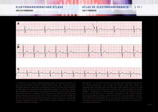 E L E K T R O K A R D I O G R A F I A K O AT L A S A 			 AT L A S D E E L E C T R O C A R D I O G R A F í A / 1 1 /
EKG ETA FARMAKOAK ECG Y FÁRMACOS
/ 362 /
II deribazioa, hiru unetan, beta-blokeatzaileen tratamendua hartzen ari
den paziente batean. A: 2/1 blokeo ABean dago, 1/1 eroapena duen
konplexu bat izan ezik, PR luzeagoarekin (gezia). B: farmakoa erretiratu
eta 24 ordura, 2. mailako blokeo ABarekin eroaten du, Mobitz I tipokoa
(Wenckebach-enfenomenoa,ikusibradiarritmienatala).C:farmakorikgabe
48 h egon ondoren, eroapena 1/1 da jadanik, oraindik ere lehen mailako
blokeo ABak jarraitzen duen arren. Nodulu ABaren mailako   blokeo AB
bat da, eta horren tratamendua farmako eragilea kentzea da. Farmakoa
ematea ezinbestekoa balitz, behin betiko taupada-markagailu bat jartzea
pentsatu beharko litzateke.  
Derivación II en tres momentos en un paciente que está bajo tratamiento
con beta-bloqueantes. En A está en bloqueo AV 2/1 salvo un
complejo que conduce 1/1 con PR más largo (flecha). En B, a las 24
horas de ser retirado el fármaco, conduce con bloqueo AV de 2º grado
Mobitz I (fenómeno de Wenckebach, ver sección de bradiarritmias).
En C, a las 48 horas sin el fármaco, conduce ya 1/1 aunque todavía
con bloqueo AV de primer grado. Se trata de un bloqueo AV a nivel del
nodo AV cuyo tratamiento es la retirada del fármaco causal. Si fuera
necesaria la administración del fármaco habría que pensar en asociar un
marcapasos definitivo.  
 