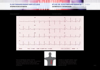 E L E K T R O K A R D I O G R A F I A K O AT L A S A 			 AT L A S D E E L E C T R O C A R D I O G R A F í A / 1 /
OINARRIAK FUNDAMENTOS
/ 35 /
E L E K T R O K A R D I O G R A F I A K O AT L A S A 			 AT L A S D E E L E C T R O C A R D I O G R A F í A / 2 /
INTERPRETATZEKO SISTEMATIKA SISTEMÁTICA DE LA INTERPRETACIÓN
/ 35 /
Bihotz bertikala Corazón vertical
Posizio bertikaleko bihotza, ohizkoa
astenikoetan. ÂQRS 90º-tik gertu, eta errotazio
horretan ezaugarriak diren QRS tarteak:
negatiboa aVL deribazioan eta positiboa aVF
deribazioan.
Corazón en posición vertical, propio
de asténicos. ÂQRS próximo a 90º,
con complejos QRS característicos
de esta rotación: negativo en aVL y
positivo en aVF.
 