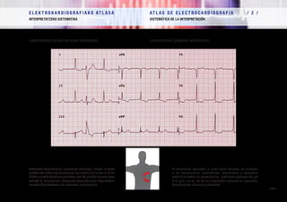 E L E K T R O K A R D I O G R A F I A K O AT L A S A 			 AT L A S D E E L E C T R O C A R D I O G R A F í A / 1 /
OINARRIAK FUNDAMENTOS
/ 37 /
E L E K T R O K A R D I O G R A F I A K O AT L A S A 			 AT L A S D E E L E C T R O C A R D I O G R A F í A / 2 /
INTERPRETATZEKO SISTEMATIKA SISTEMÁTICA DE LA INTERPRETACIÓN
/ 37 /
Leborrotazioa (erloju-orratzen kontrakoa) Levorrotación (rotación antihoraria)
Ezkerreko bentrikuluak, aurrerantz biratzean, bihotz aurreko
tarteko eta eskuineko deribazioei egin behar die aurre: R uhina
bihotz aurreko deribazio guztietan, eta Rs, qR edo R purua ager
daiteke V2
deribazioan. Ezkerreko bentrikuluaren hipertrofian,
aurreko hemiblokeoan eta obesitean gertatzen da.
El ventrículo izquierdo, al girar hacia delante, se enfrenta
a las derivaciones precordiales intermedias y derechas:
onda R en todas las precordiales, pudiendo aparecer Rs, qR
ó R pura en V2
. Se da en hipertrofia ventricular izquierda,
hemibloqueo anterior y obesidad
 