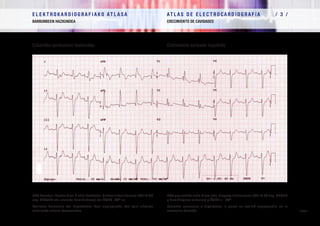 E L E K T R O K A R D I O G R A F I A K O AT L A S A 			 AT L A S D E E L E C T R O C A R D I O G R A F í A / 1 /
OINARRIAK FUNDAMENTOS
/ 58 /
E L E K T R O K A R D I O G R A F I A K O AT L A S A 			 AT L A S D E E L E C T R O C A R D I O G R A F í A / 3 /
BARRUNBEEN HAZKUNDEA CRECIMIENTO DE CAVIDADES
/ 58 /
Ezkerreko aurikularen hazkundea Crecimiento auricular izquierdo
EKG honetan ikusten dira: P uhin hozkatua, blokeo trifaszikularra (PR=0,26
seg, HBEsAB eta aurreko hemiblokeoa) eta ÂQRS -90º-ra.
Paziente koronario eta hipertentso honi angioplastia bat egin zitzaion
eskuineko arteria koronarioan.
ECG que exhibe onda P mellada, bloqueo trifascicular (PR=0,26 seg, BRDHH
y hemibloqueo anterior) y ÂQRS a - 90º.
Paciente coronario e hipertenso, a quien se realizó angioplastia en la
coronaria derecha.
 