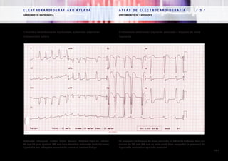 E L E K T R O K A R D I O G R A F I A K O AT L A S A 			 AT L A S D E E L E C T R O C A R D I O G R A F í A / 1 /
OINARRIAK FUNDAMENTOS
/ 70 /
E L E K T R O K A R D I O G R A F I A K O AT L A S A 			 AT L A S D E E L E C T R O C A R D I O G R A F í A / 3 /
BARRUNBEEN HAZKUNDEA CRECIMIENTO DE CAVIDADES
/ 70 /
Ezkerreko bentrikuluaren hazkundea, ezkerreko adarraren
blokeoarekin batera
Ezkerreko adarraren blokeo baten kasuan, Sokolow-Lyon-en indizea
45 mm-tik gora egoteak (60 mm kasu honetan) ezkerreko bentrikuluaren
hipertrofia ere badagoela susmatzeko arrazoiak ematen dizkigu.
Crecimiento ventricular izquierdo asociado a bloqueo de rama
izquierda
En presencia de bloqueo de rama izquierda, el índice de Sokolow-Lyon por
encima de 45 mm (60 mm en este caso) hace sospechar la presencia de
hipertrofia ventricular izquierda asociada.
 