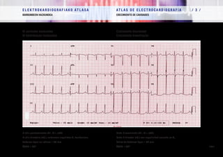E L E K T R O K A R D I O G R A F I A K O AT L A S A 			 AT L A S D E E L E C T R O C A R D I O G R A F í A / 1 /
OINARRIAK FUNDAMENTOS
/ 79 /
E L E K T R O K A R D I O G R A F I A K O AT L A S A 			 AT L A S D E E L E C T R O C A R D I O G R A F í A / 3 /
BARRUNBEEN HAZKUNDEA CRECIMIENTO DE CAVIDADES
/ 79 /
Bi aurikulen hazkundea
Bi bentrikuluen hazkundea
P uhin puntazorrotza (DII, DIII, aVF)
P uhin bimodala (+/-), nabarmen negatiboa V1
deribazioan
Sokolow-Lyon-en indizea = 50 mm
ÂQRS = 76º
Crecimiento biauricular
Crecimiento biventricular
Onda P acuminada (DII, DIII, aVF)
Onda P bimodal (+/-) con negatividad acusada en V1
Índice de Sokolow-Lyon = 50 mm
ÂQRS = 76º
 