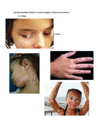 Atlas Dermatología; Pediatría II– Gustavo Delgado L. María Laura Londoño C.
1) Vitíligo
Poliosis
 