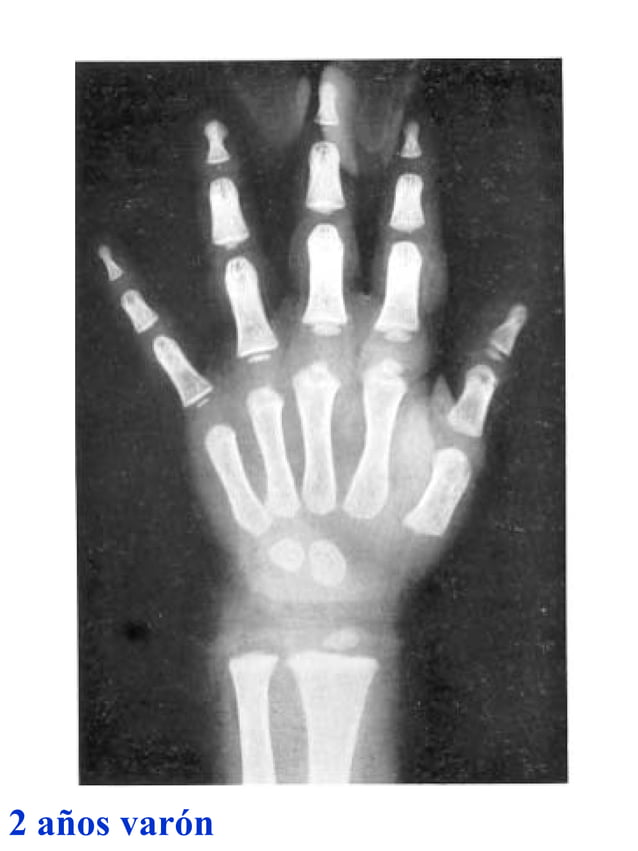 Atlas greulich y pyle PDF