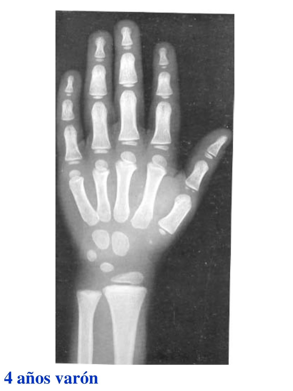 Atlas greulich y pyle