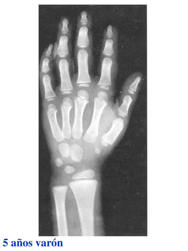 Atlas greulich y pyle