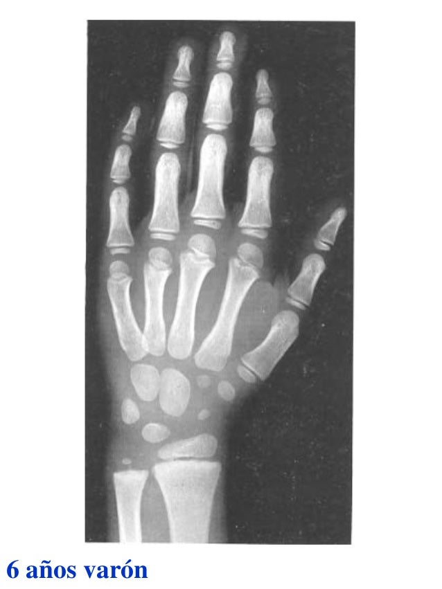 Atlas greulich y pyle