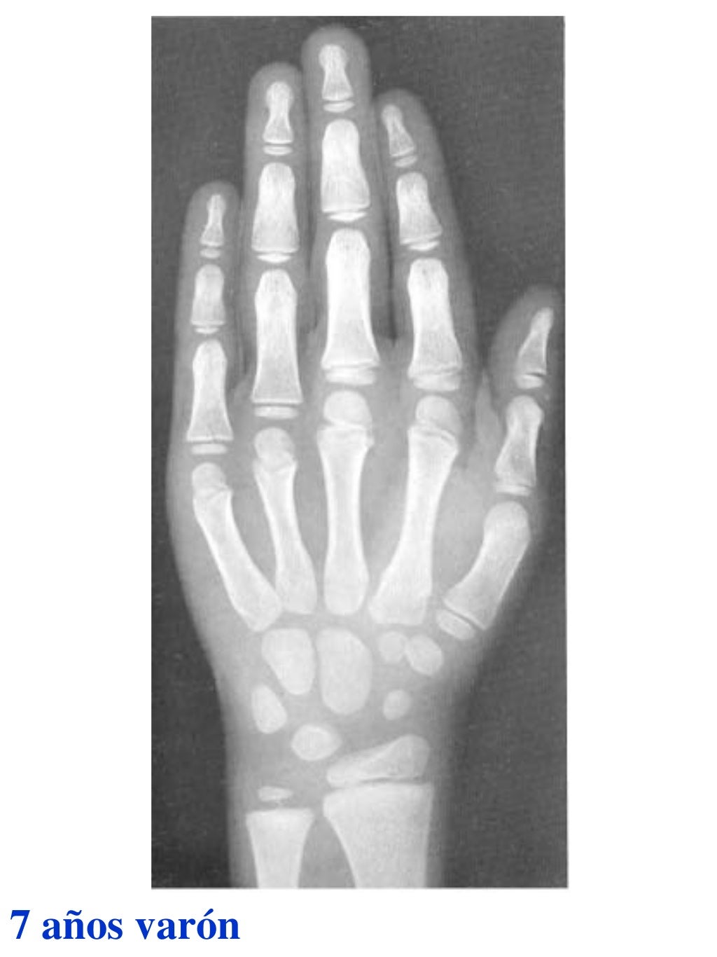 Atlas greulich y pyle