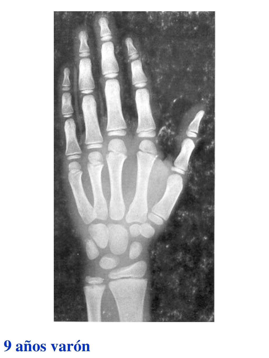 Atlas greulich y pyle