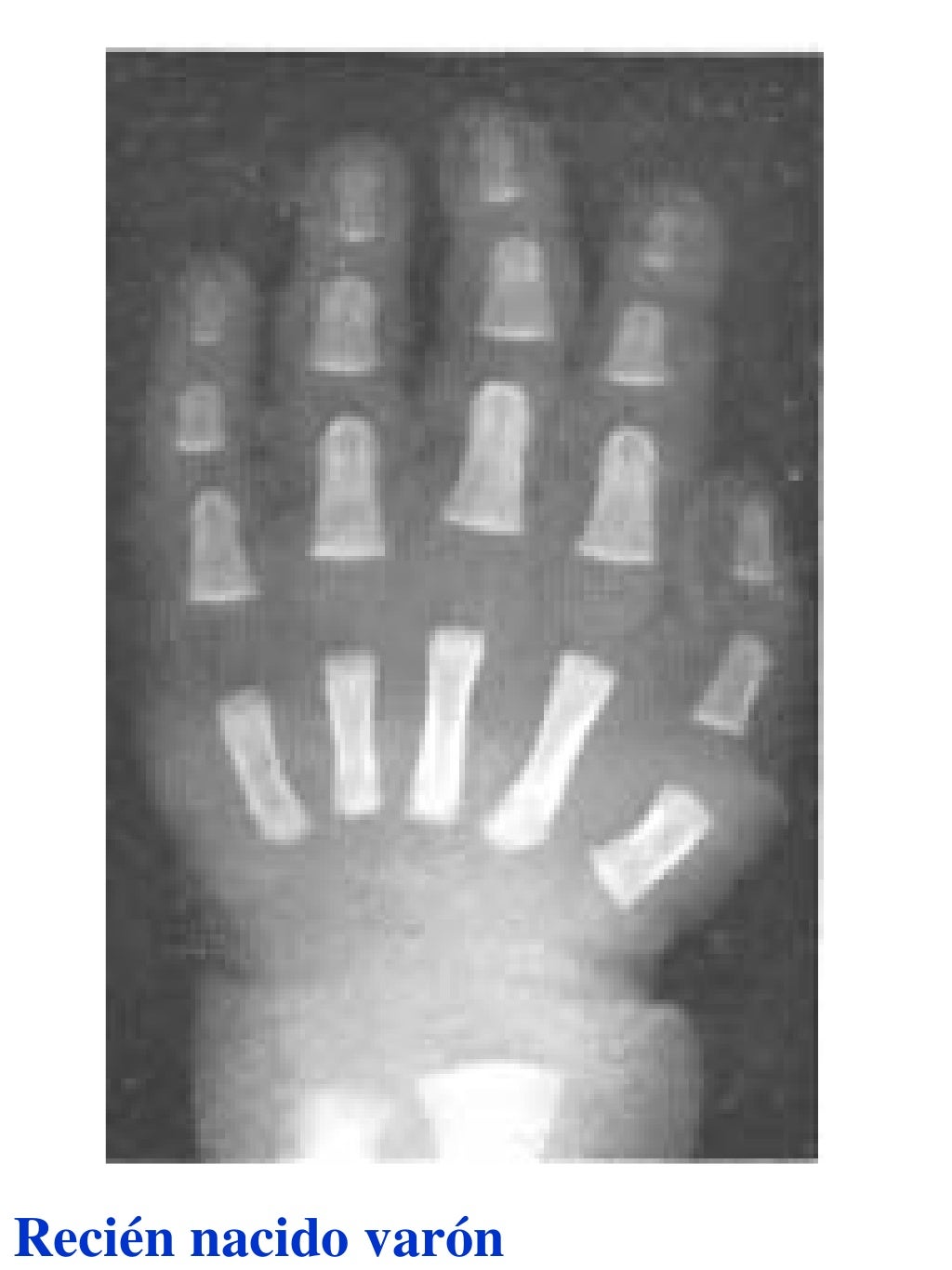 Atlas greulich y pyle