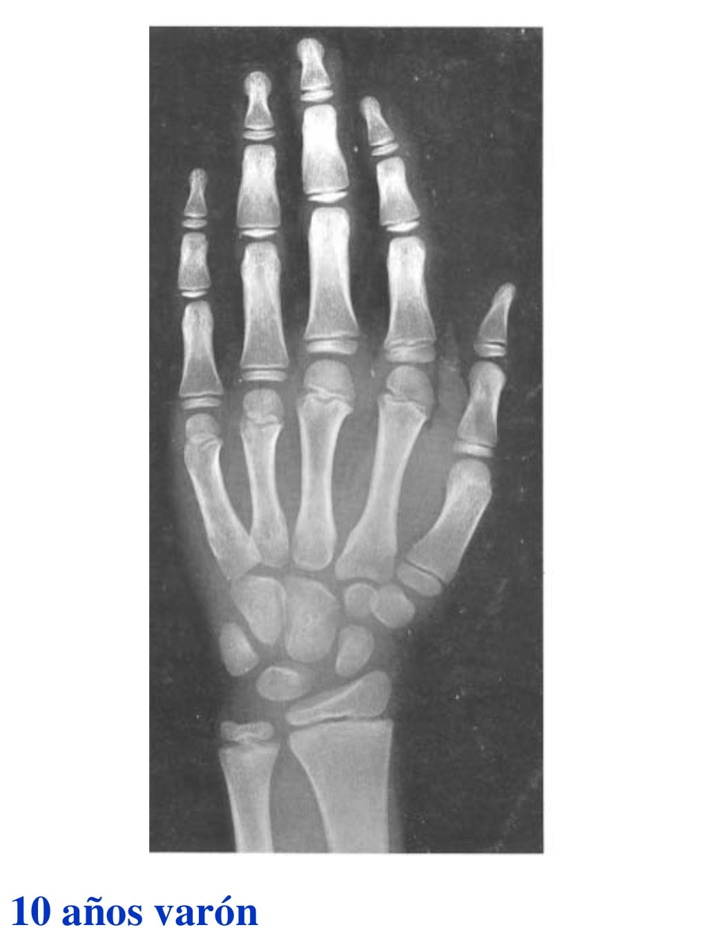 Atlas greulich y pyle