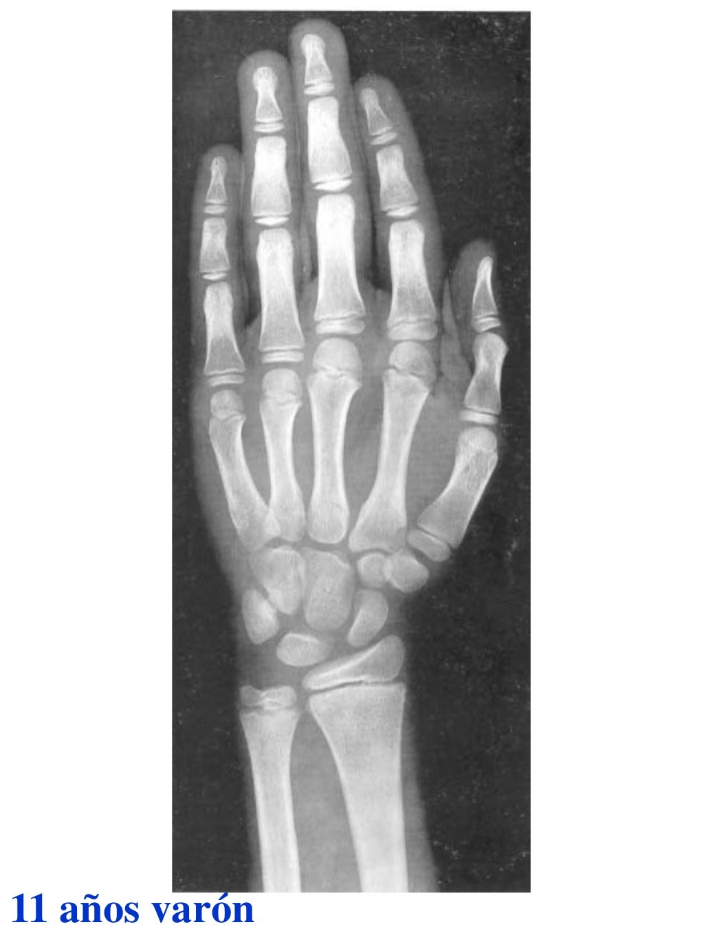 Atlas greulich y pyle