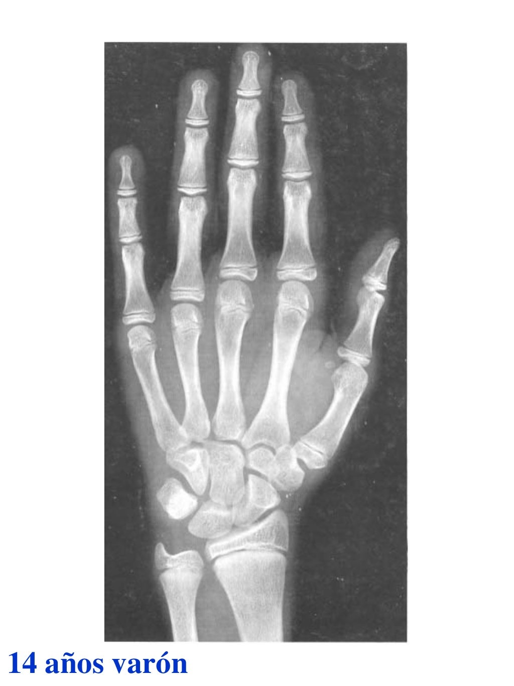 Atlas greulich y pyle