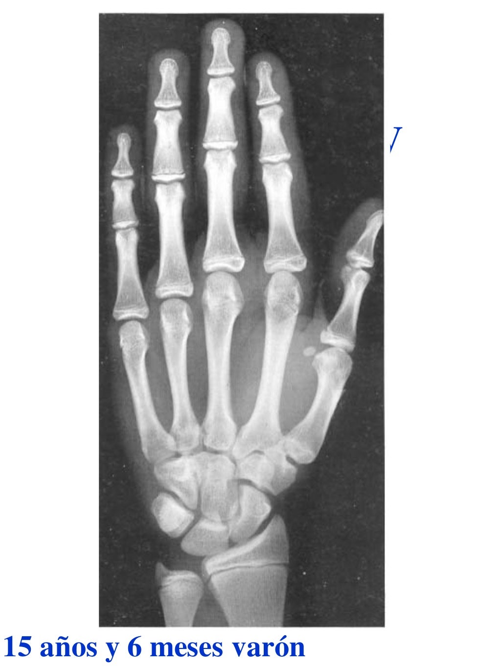 Atlas greulich y pyle