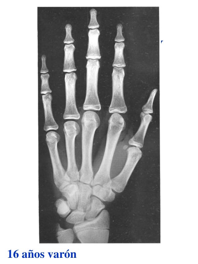 Atlas greulich y pyle