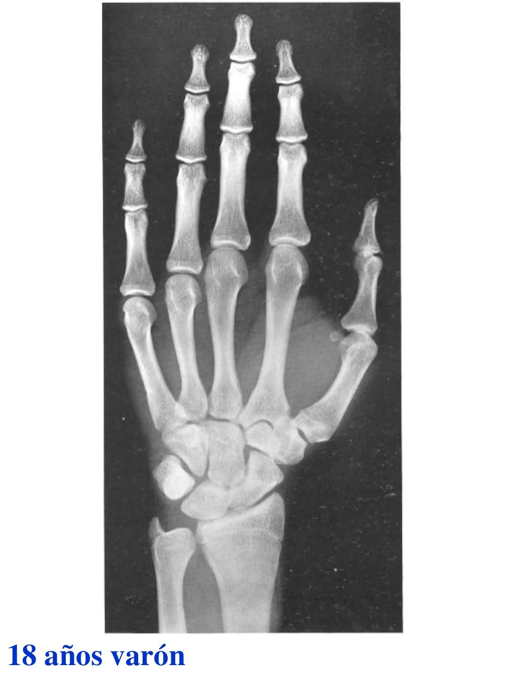 Atlas greulich y pyle