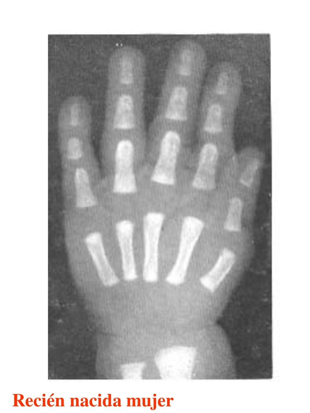 Atlas greulich y pyle