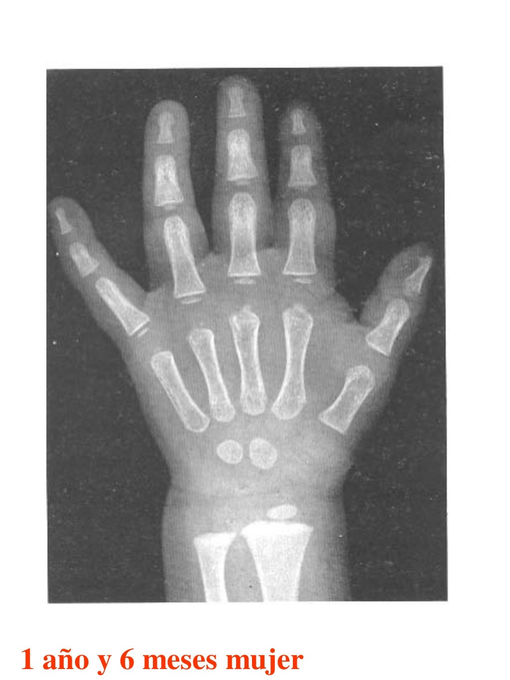 Atlas greulich y pyle