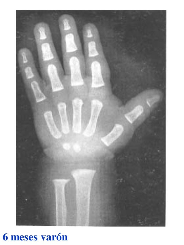 Atlas greulich y pyle