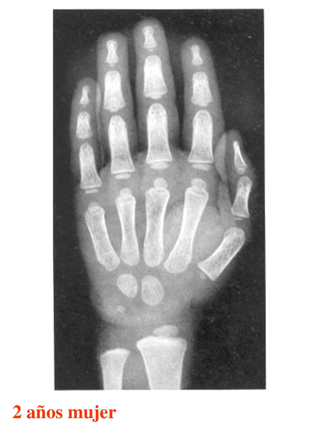 Atlas greulich y pyle