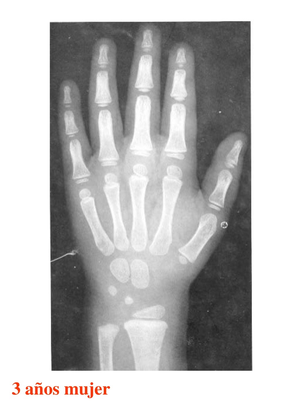 Atlas greulich y pyle