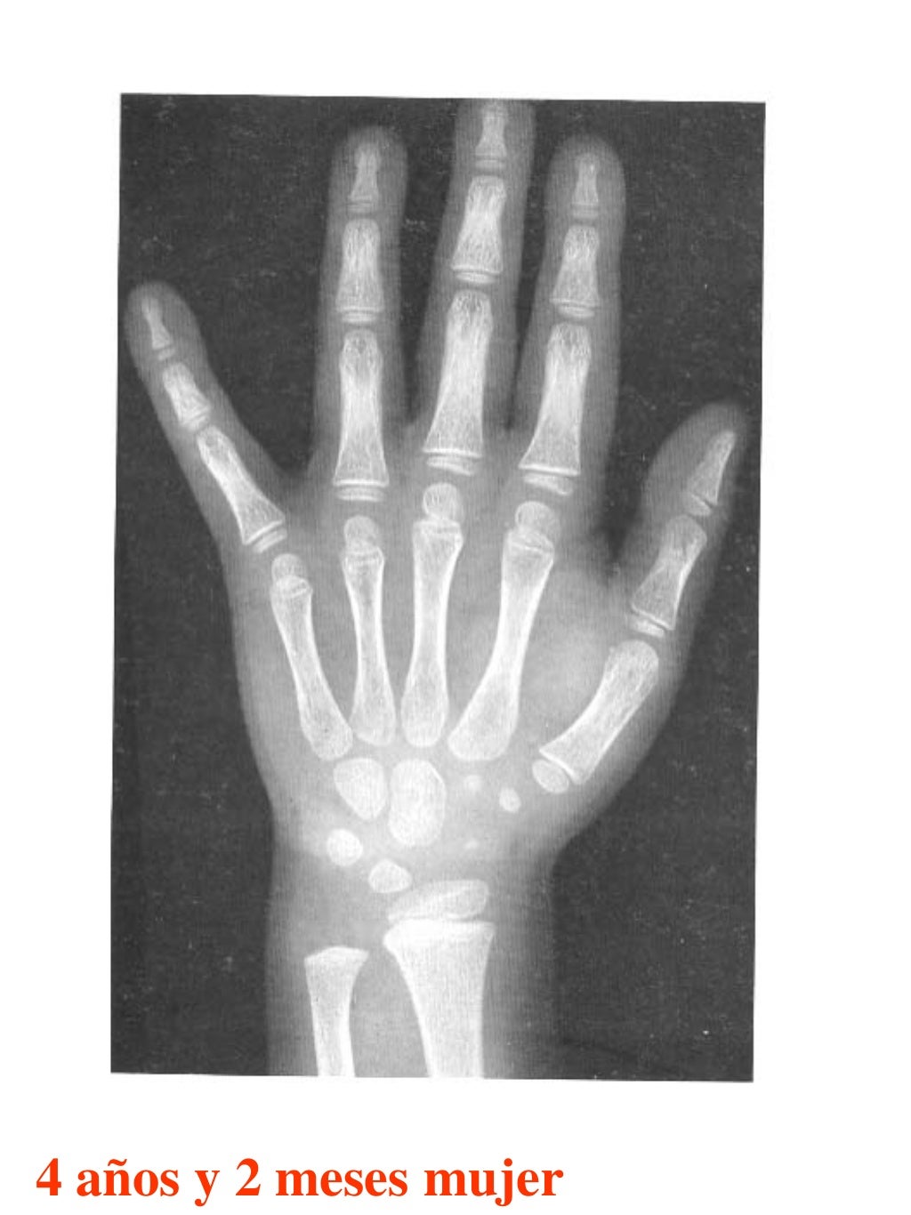 Atlas greulich y pyle