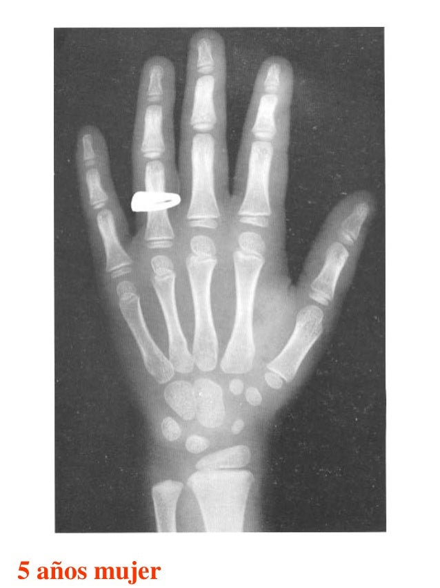 Atlas greulich y pyle