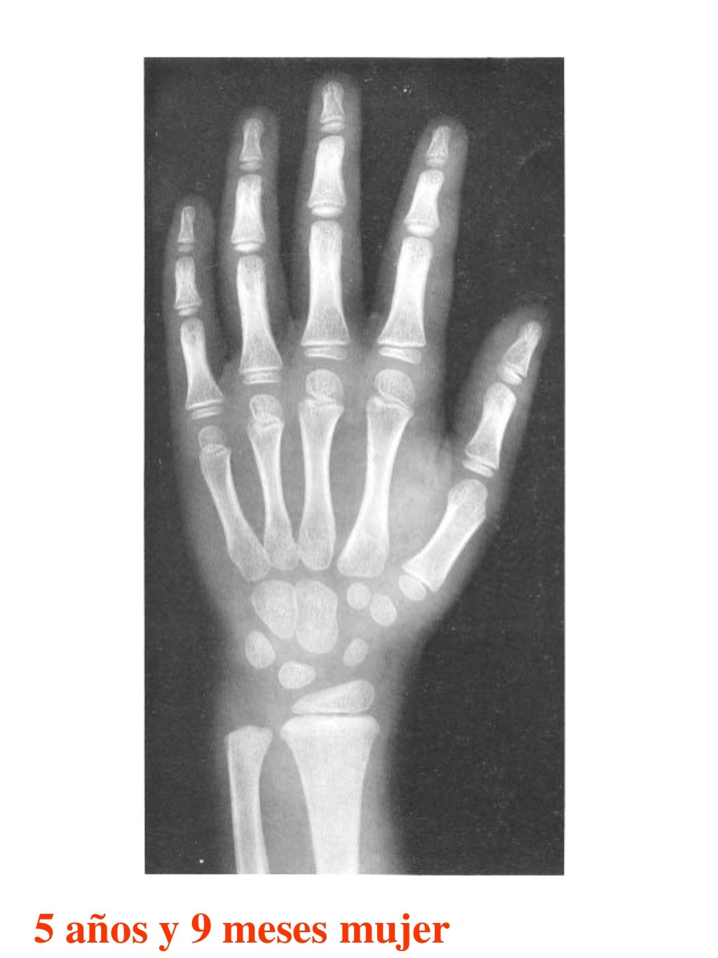 Atlas greulich y pyle