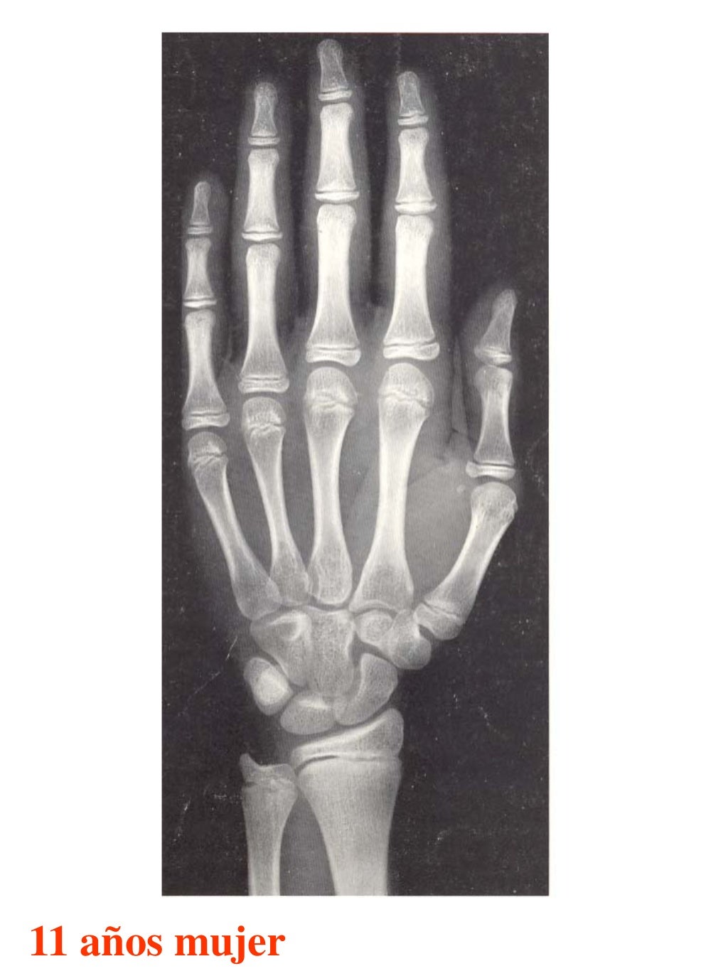 Atlas greulich y pyle