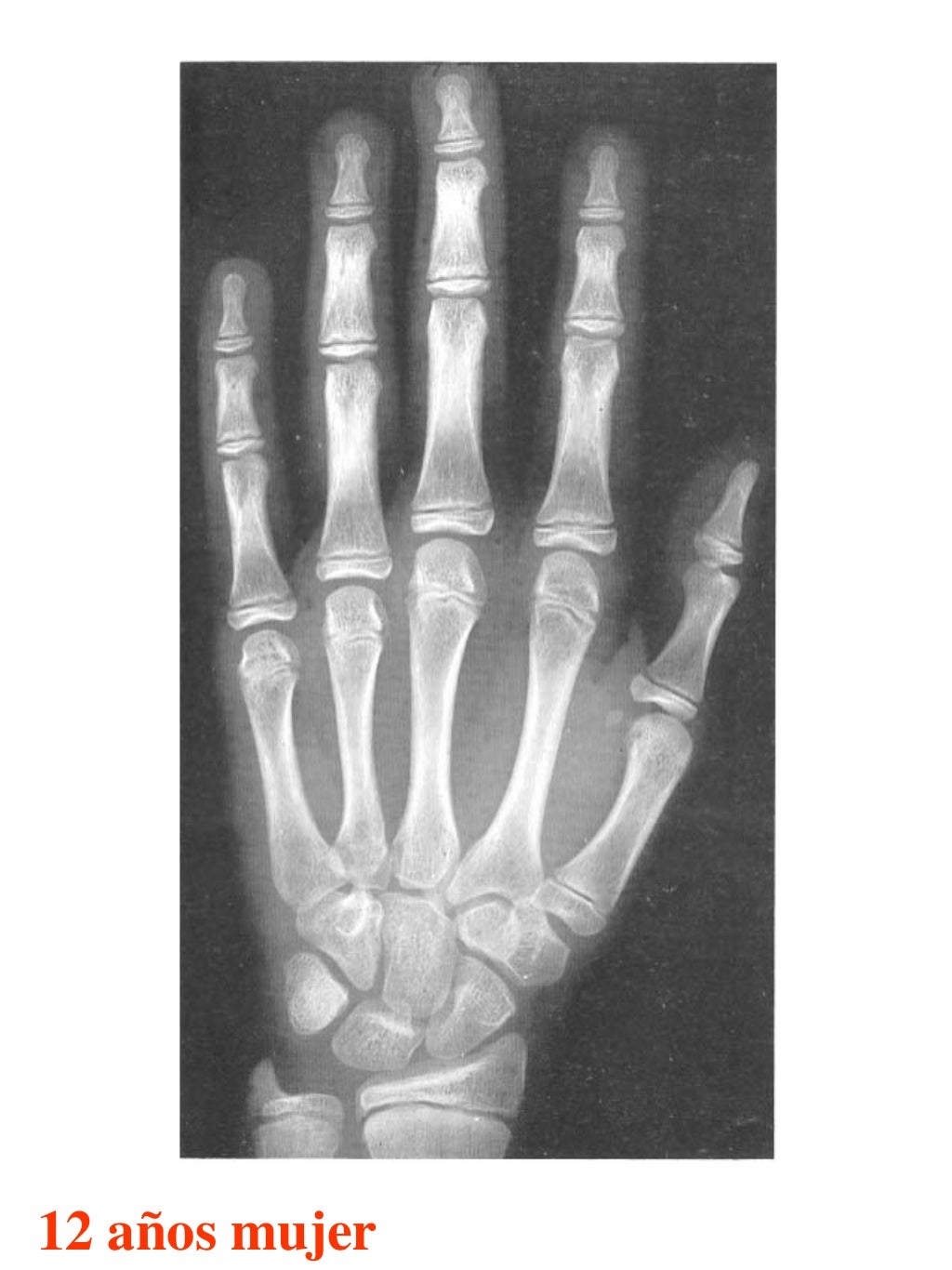 Atlas greulich y pyle