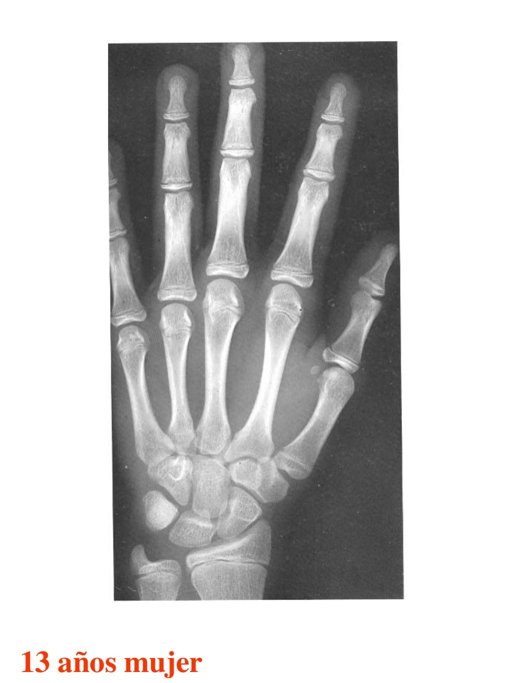 Atlas greulich y pyle