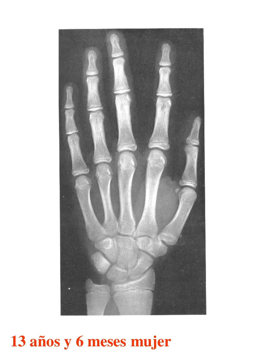 Atlas greulich y pyle