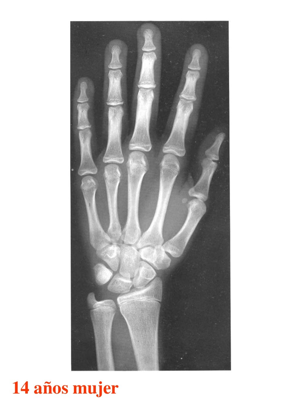 Atlas greulich y pyle