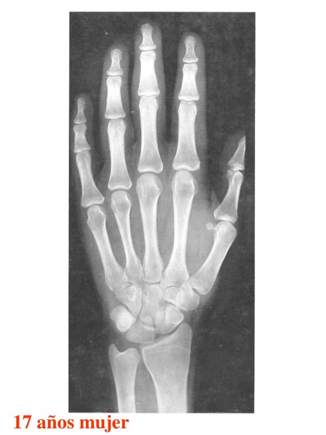 Atlas greulich y pyle