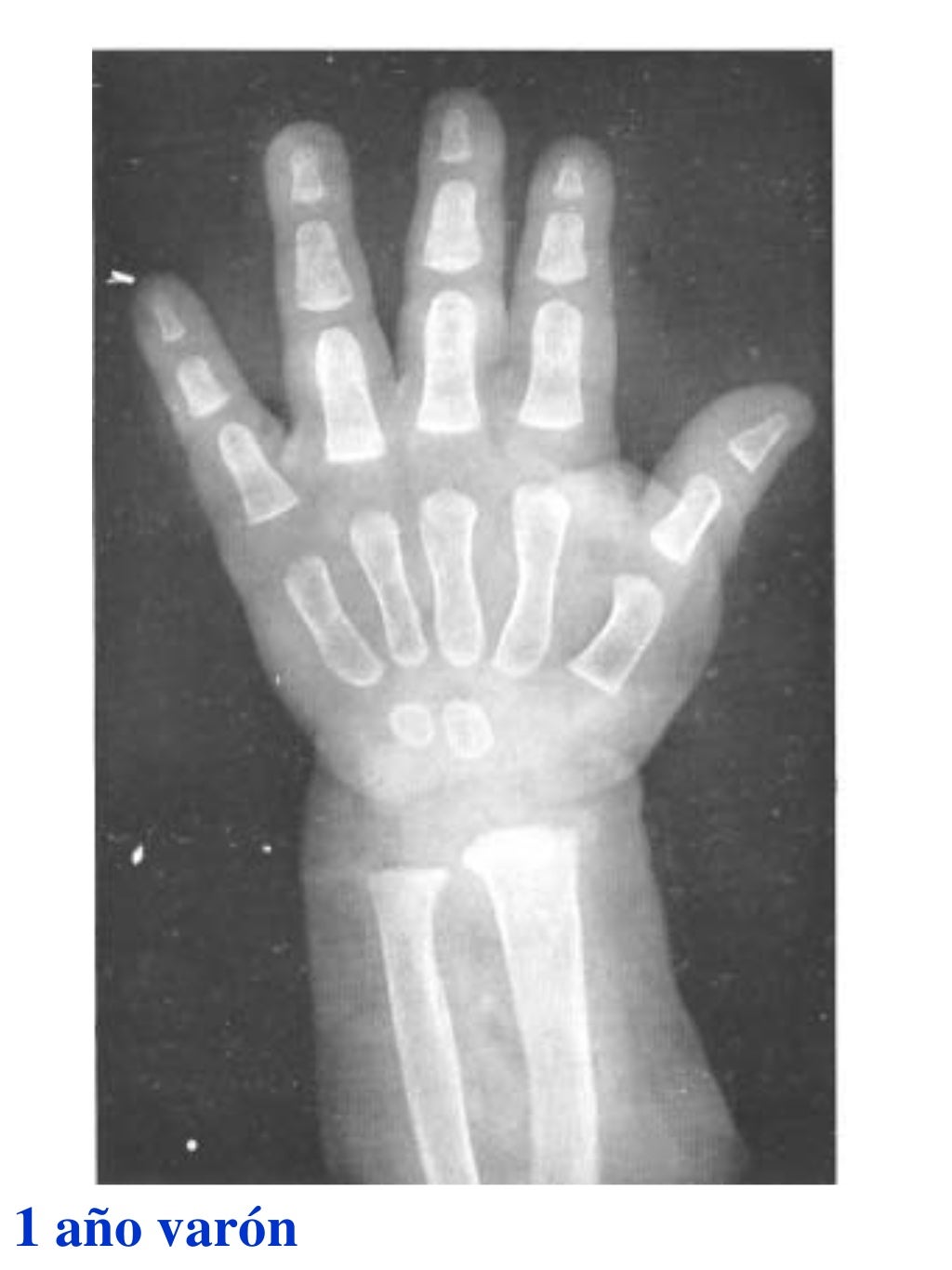 Atlas greulich y pyle