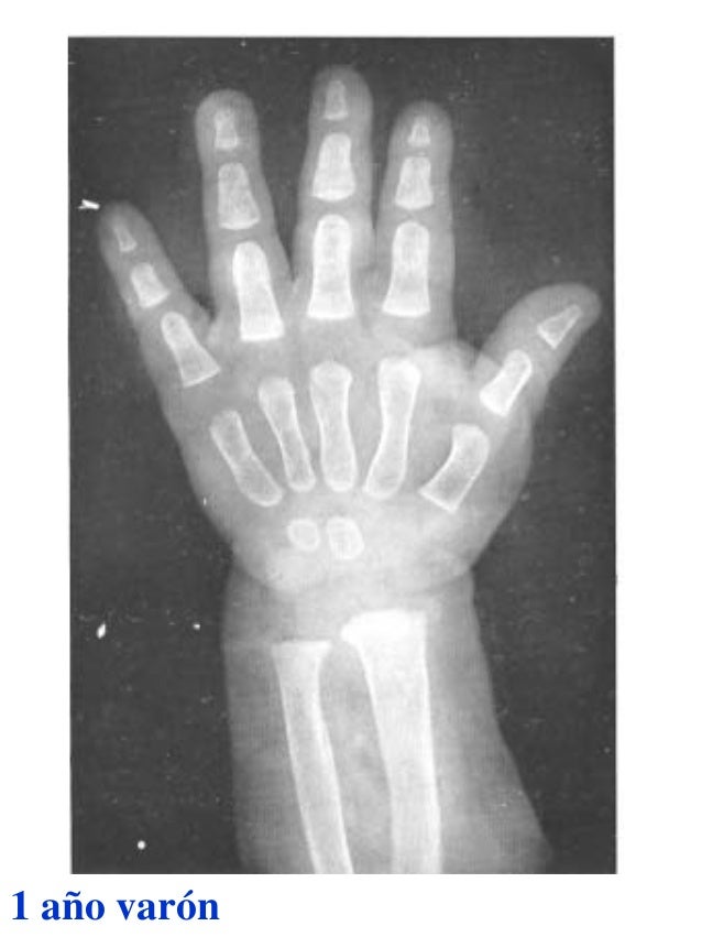 Atlas greulich y pyle